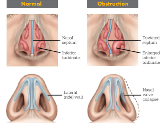 Sinus Problems - Dr. James Go